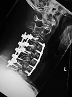 Anterior and posterior cervical fusion with bone struts